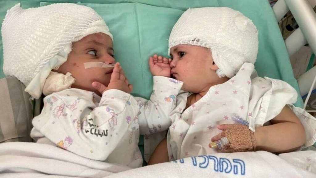 Σπάνια εγχείρηση στο Ισραήλ: Σιαμαία ενωμένα στο κεφάλι είδαν για πρώτη φορά το ένα το άλλο - ΠΕΡΙΕΡΓΑ