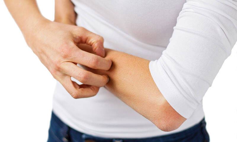 bigstock-Eczema-dermatitis-and-itchy-s-79387837