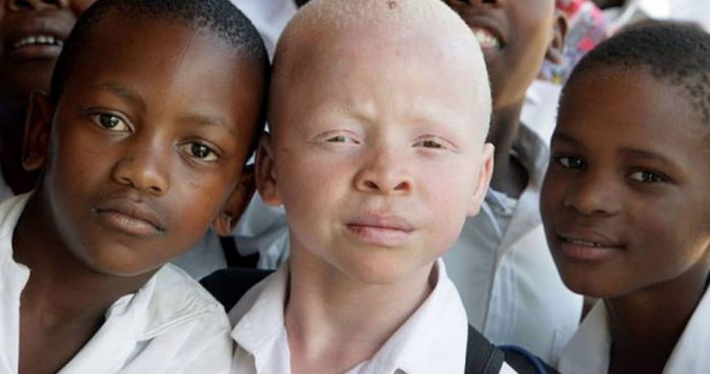 albinos