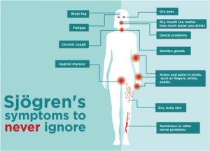 Παγκόσμια Ημέρα Sjögren’s : Η πλειοψηφία των ασθενών με ξηροφθαλμία είναι γυναίκες μετά την εμμηνόπαυση. - ΕΛΛΑΔΑ