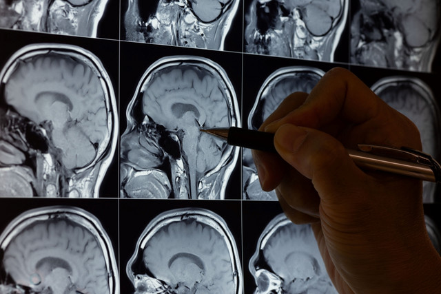 Οι-ανθρώπινοι-εγκέφαλοι-γέρασαν-ραγδαία-στην-πανδημία-–-και-το-πρόβλημα-δεν-ήταν-μόνο-ο-κορονοϊός