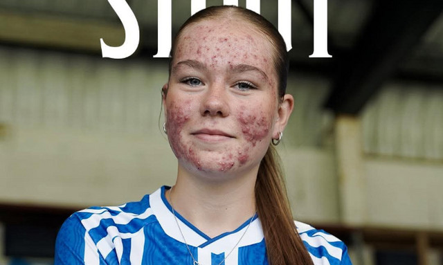 Σάλος-με-διαδικτυακό-bullying-σε-16χρονη-ποδοσφαιρίστρια-της-Κιλμάρνοκ-–-Την-χλεύασαν-για-την-ακμή-της