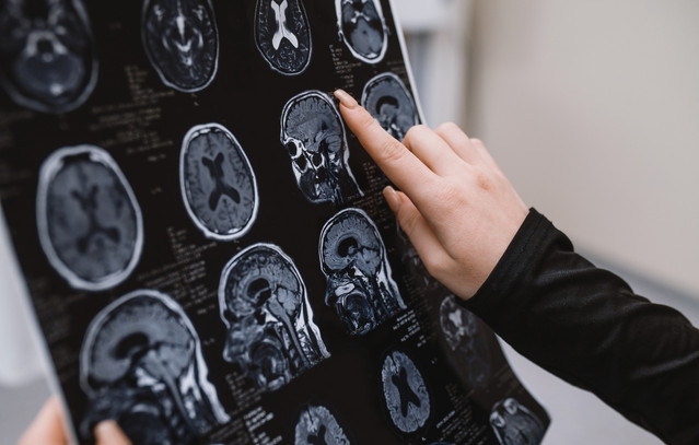 Νέα-θεραπεία-για-το-Αλτσχάιμερ-καθαρίζει-τον-εγκέφαλο-από-πλάκες-αμυλοειδούς-β-μέσα-σε-λίγες-ώρες