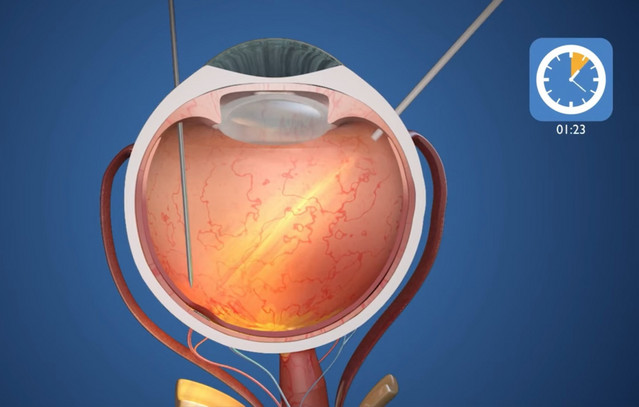Επανάσταση-στην-ιατρική:-Εμφύτευμα-ματιού-με-τεχνητή-νοημοσύνη-χαρίζει-ξανά-όραση-σε-τυφλούς-ασθενείς