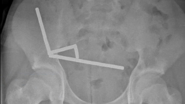 Έφηβος-έχασε-μέρος-του-εντέρου-του-αφού-κατάπιε-σχεδόν-200-μαγνήτες-–-Οι-προειδοποιήσεις-των-γιατρών