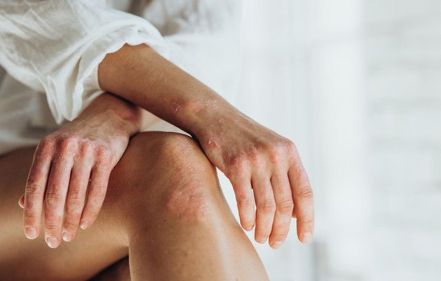 Η-ψωρίαση-δεν-σταματά-στο-δέρμα