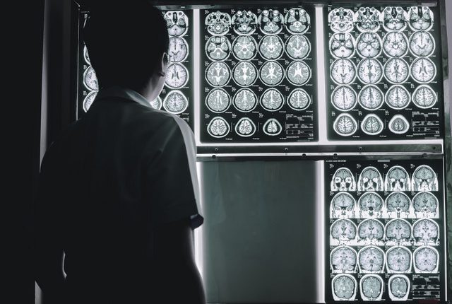 1-στις-3-περιπτώσεις-άνοιας-οφείλεται-σε-ασθένεια-εκτός-του-εγκεφάλου