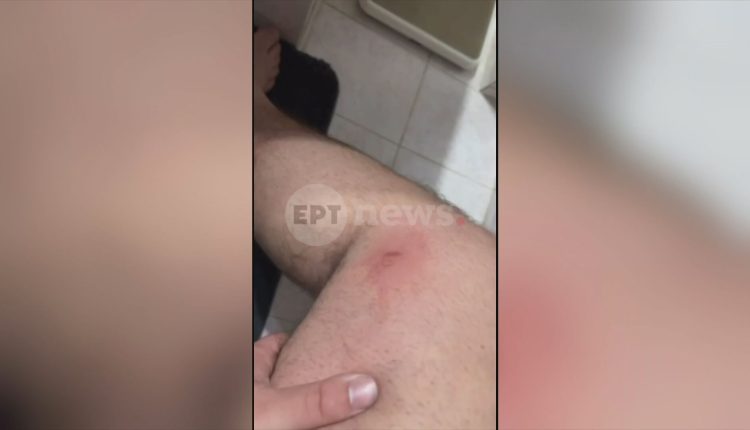 Αίγιο:-Με-σκάγια-από-φυσίγγια-για-κυνήγι-μεγάλων-θηραμάτων-πυροβόλησε-τους-ανήλικους-ο-46χρονος-–-Αποκλειστικές-φωτογραφίες-των-τραυμάτων