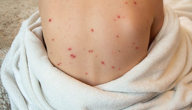 «Καμπανάκι»-από-τον-ΕΟΔΥ-για-την-ιλαρά-–-«Συνεχίζει-να-προκαλεί-σοβαρές-επιπλοκές-και-θανάτους»