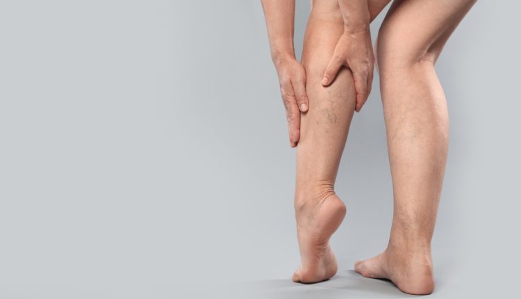 Θρόμβωση-και-κιρσοί:-Νέες-τεχνικές-χωρίς-νυστέρι-και-καινοτόμες-παρεμβάσεις-που-σώζουν-ζωές