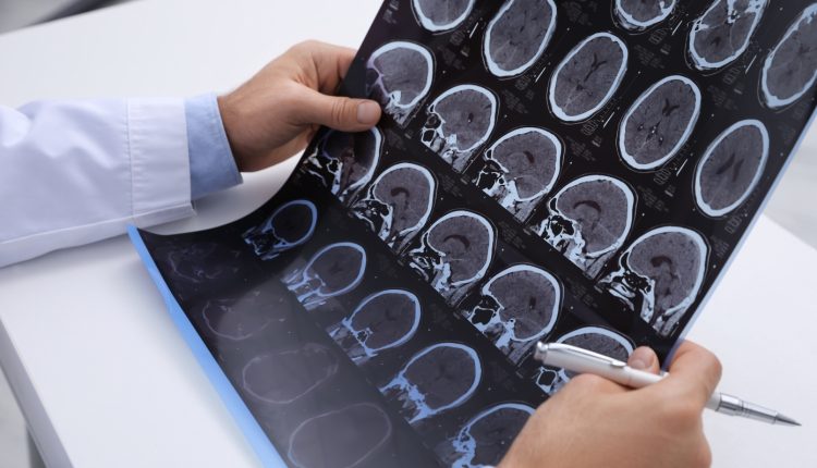 Πολλαπλή-Σκλήρυνση:-Η-νόσος-με-τα-πολλά-πρόσωπα