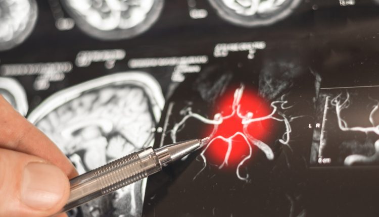 Εργαλείο-ai-προβλέπει-το-Αλτσχάιμερ-με-ακρίβεια-93%