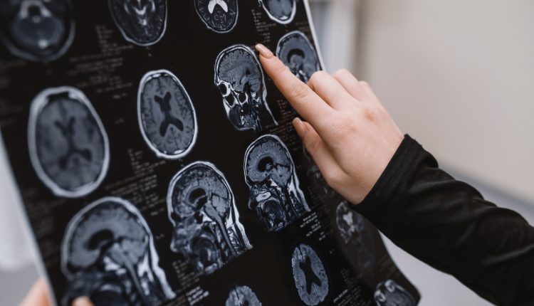 Εγκεφαλικό:-Πόσο-σας-επηρεάζει-το-οικογενειακό-ιστορικό