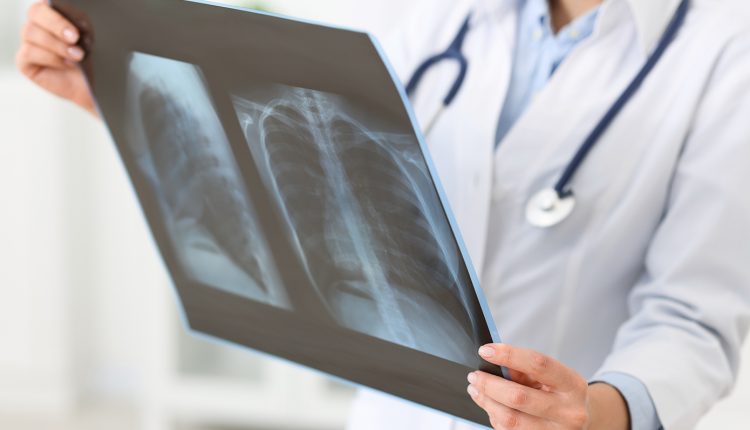 Άνθρωποι-χωρίς-φωνή-οι-ασθενείς-με-φυματίωση-–-Πενταπλάσια-τα-περιστατικά-στην-Ελλάδα-από-αυτά-που-καταγράφονται-βάσει-της-κατανάλωσης-φαρμάκων