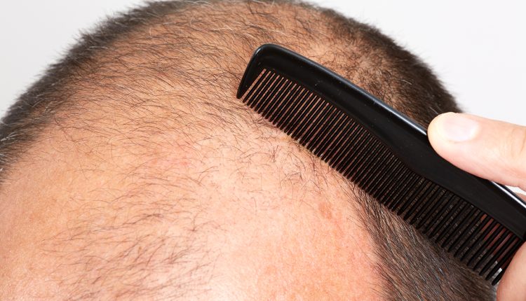 Τέλος-η-φαλάκρα;-Ορός-«θαύμα»-φέρνει-τα-πάνω-κάτω-στην-ανάπτυξη-μαλλιών