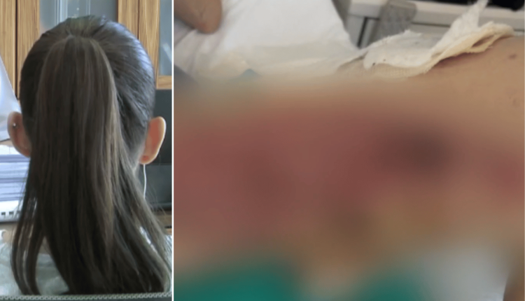 Συγκλονίζει-η-20χρονη-εγκαυματίας-στη-Θεσσαλονίκη:-«Ο-γιατρός-μου-έριξε-ένα-υγρό-και-άρχισα-να-καίγομαι-αφόρητα»